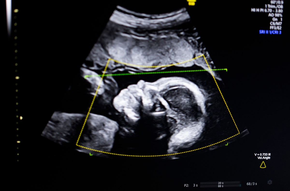 BioticsAI, which won Disrupt’s Battlefield competition in 2023, gains FDA approval for its AI-powered fetal ultrasound product 